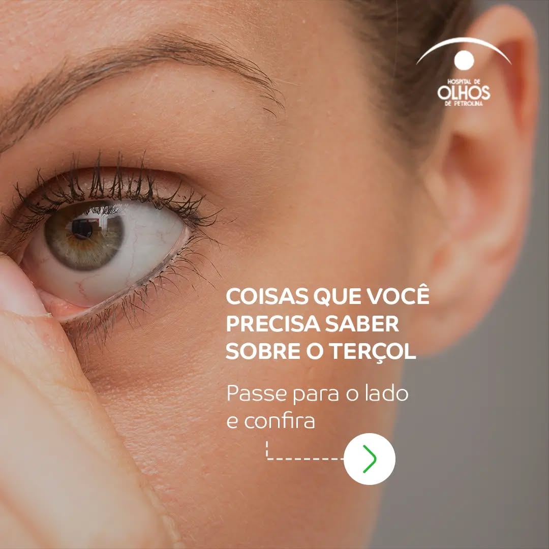 Coisas que você precisa saber sobre o Terçol